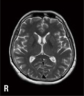 T2WI画像1