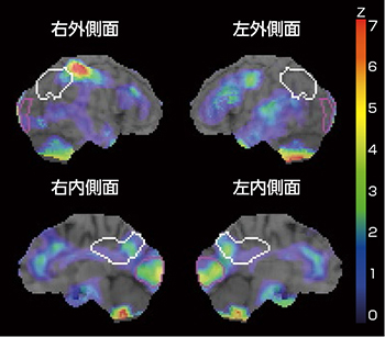 脳血流SPECT 3D-SSP画像