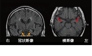 頭 前頭葉 型 認知 症 側