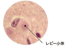 レビー小体の画像