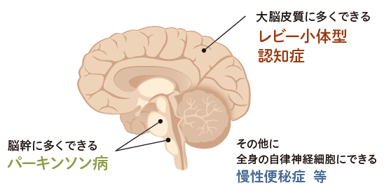 脳のイラストと説明（大脳皮質に多くできるレビー小体型認知症、脳幹に多くできるパーキンソン病、全身の自律神経細胞にできる
慢性便秘症等）