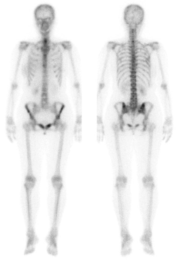 肝転移及び多発性骨転移のFDG-PET/CT画像