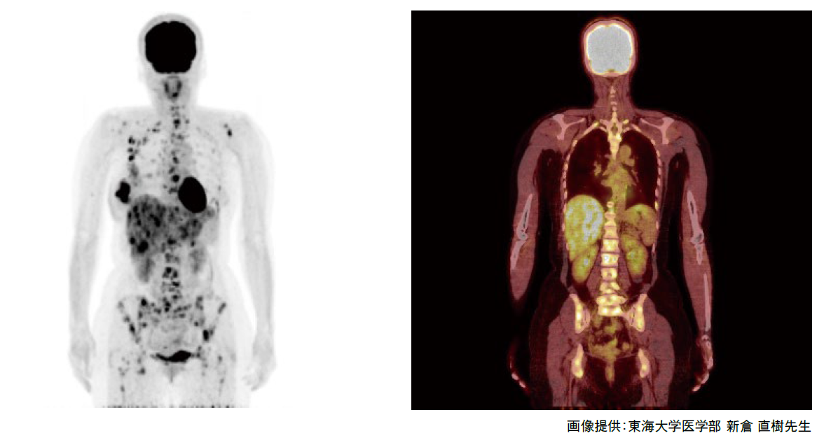 左骨シンチ、右FDG-PET