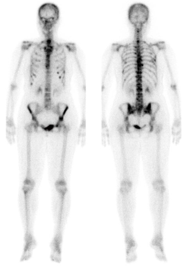 脊椎および骨盤に広範な高集積を認めた骨シンチ画像