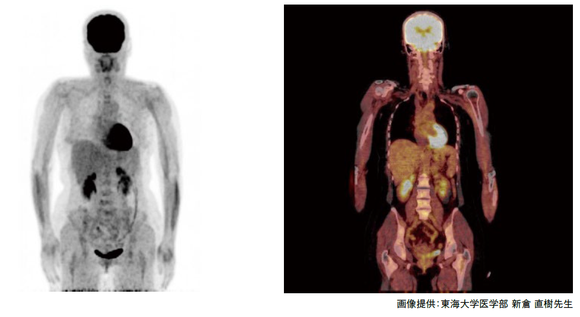 治療が奏効することでFDGの取り込みが消失しているFDG-PET/CT画像