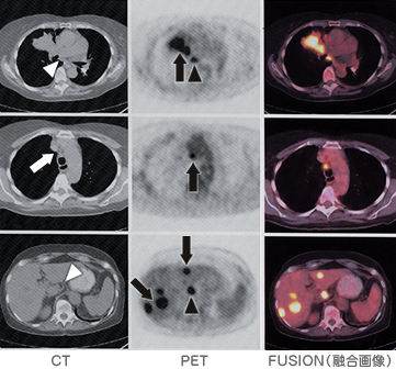 肺癌の転移診断