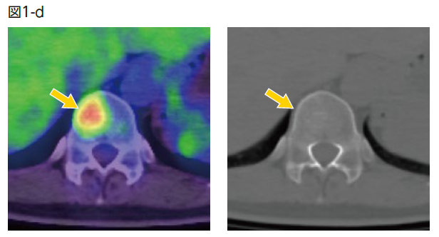PET/CT融合画像および非造影CT(骨条件)