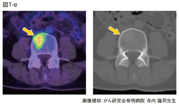 PET/CT融合画像および非造影CT(骨条件)　２