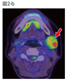 PET/CT融合画像