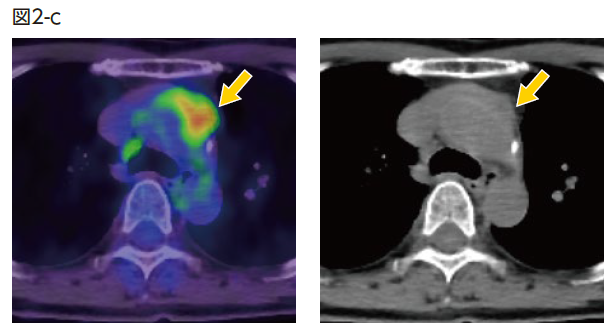 PET/CT融合画像および非造影CT