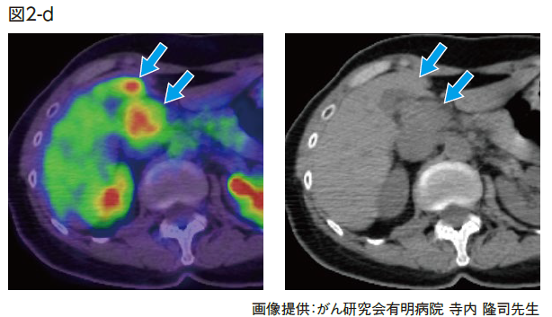 PET/CT融合画像および非造影CT　2