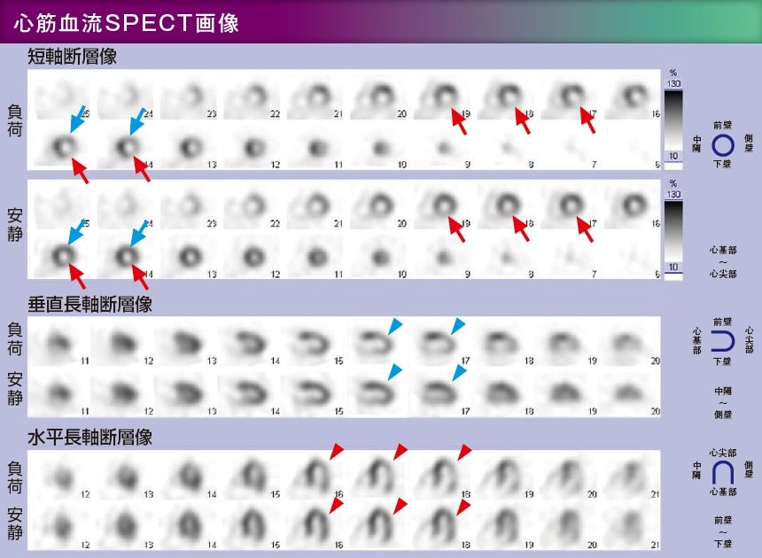 心筋血流SPECT画像　短軸断層像　垂直長軸断層像　水平長軸断層像　負荷　安静