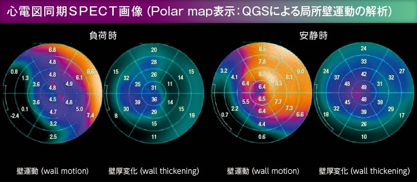 心電図同期SPECT画像(Polar map表示:QGSによる局所壁運動の解析)