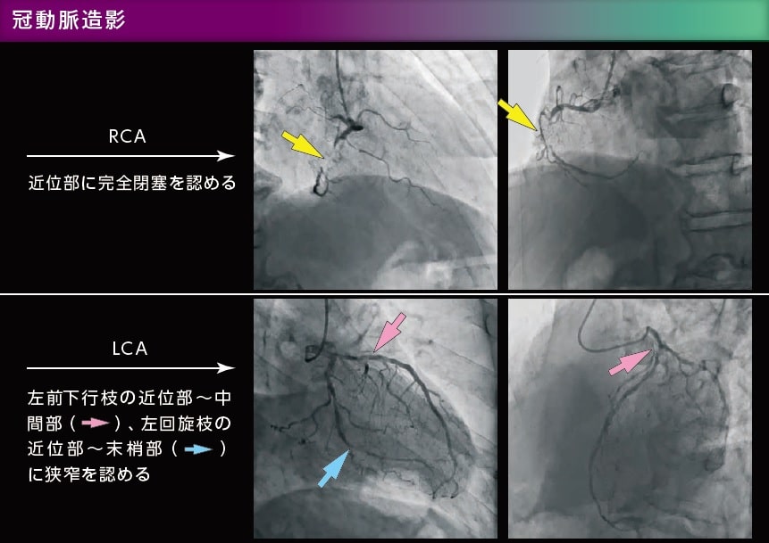 冠動脈造影　RCA LCA