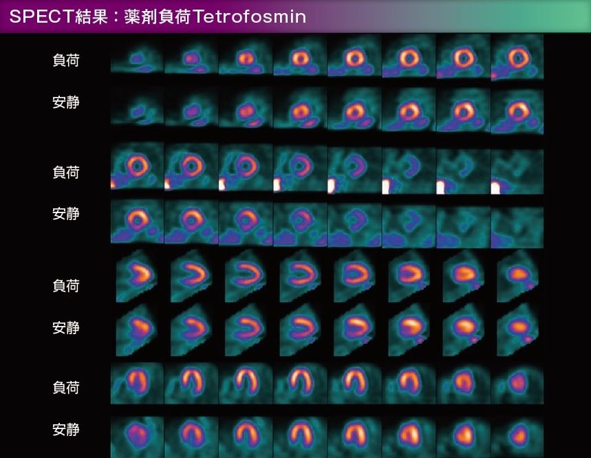 SPECT結果:薬剤負荷Tetrofosmin