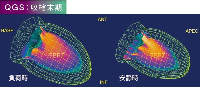 QGS画像:収縮末期　安静時と負荷時