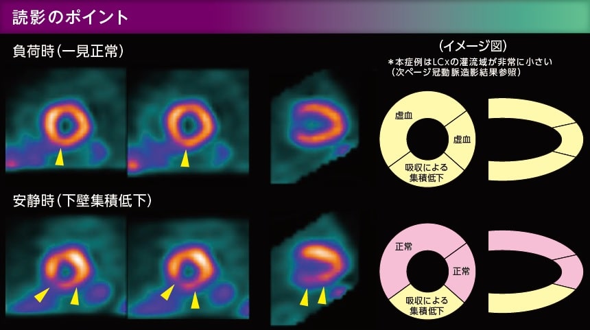 読影のポイント　SPECT画像 負荷時　安静時