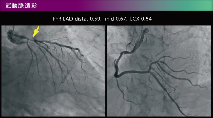 冠動脈造影 FFR画像