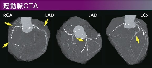 冠動脈CTA画像