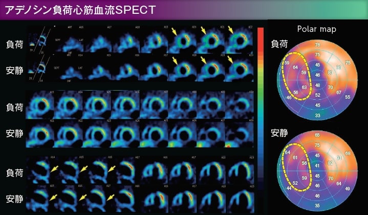 アデノシン負荷心筋血流SPECT画像