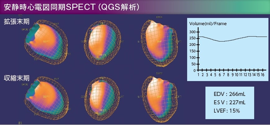 安静時心電図同期SPECT QGS解析