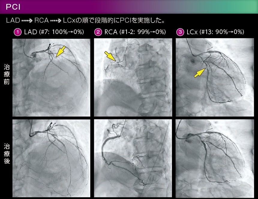 PCI画像　LAD.RCA.LCx