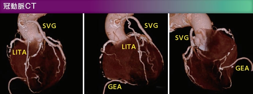 冠動脈CT画像