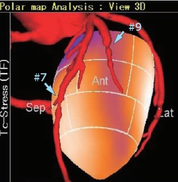 冠動脈CTと負荷心筋血流SPECTとのフュージョン画像