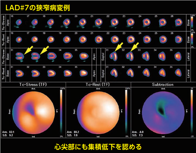 LAD#7の狭窄病変例