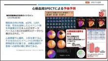 エビデンスを基にした心筋SPECT検査を有効活用