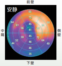 下壁の心筋バイアビリティ