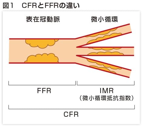 図1 CFRとFFRの違い