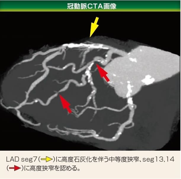 冠動脈CTA画像