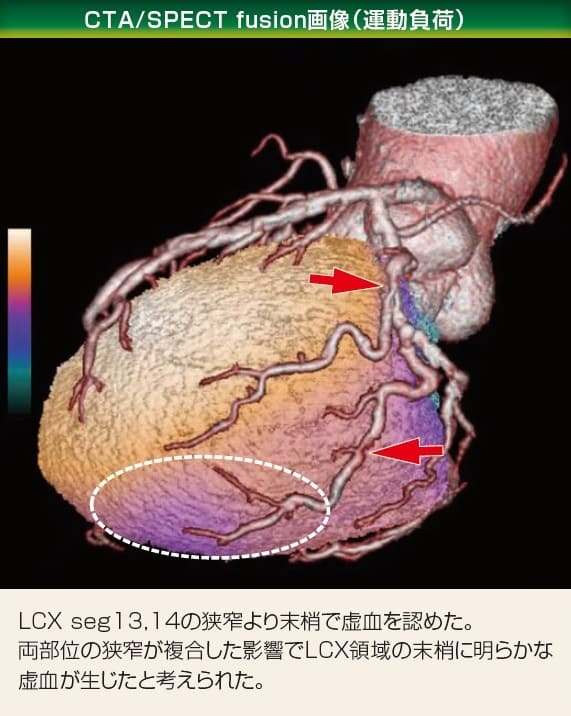 CTA/SPECT fusion画像(運動負荷)