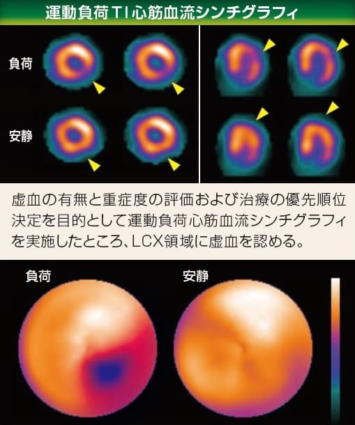 運動負荷 Tl 心筋血流シンチグラフィ