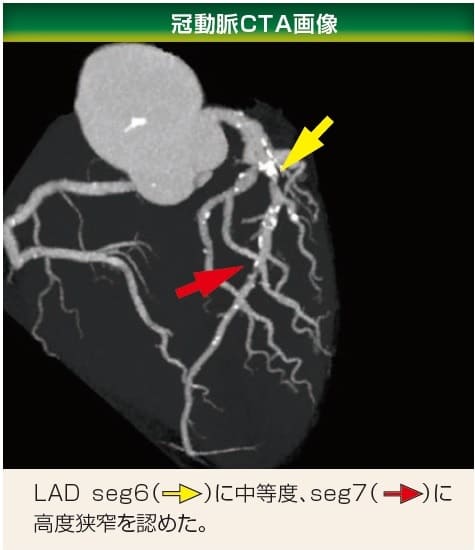 冠動脈CTA画像