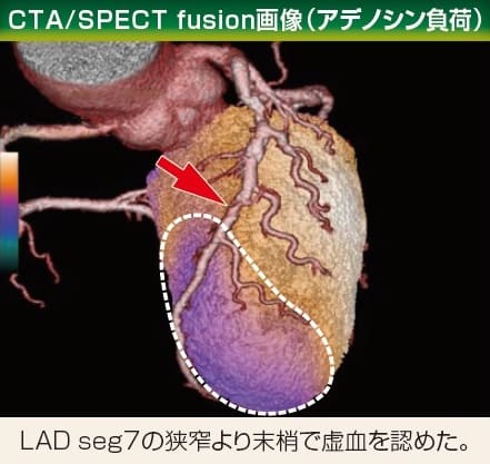 CTA/SPECT fusion画像(運動負荷)
