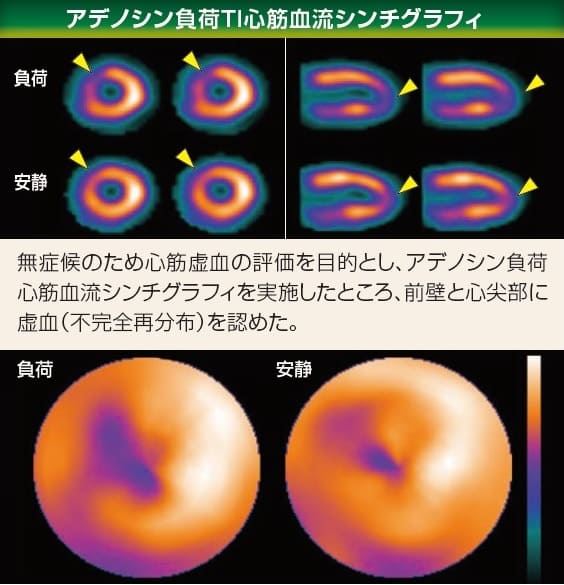 運動負荷 Tl 心筋血流シンチグラフィ