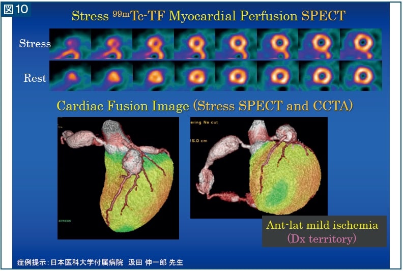 図10　Stress 99mTc-TF Myocardial Perfusion SPECT