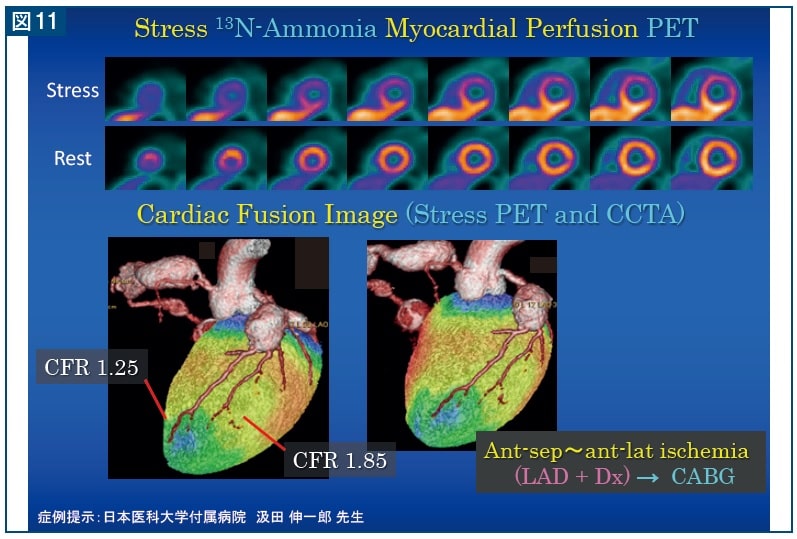 図11 Stress 13N-Ammonia Myocardial Perfusion PET
