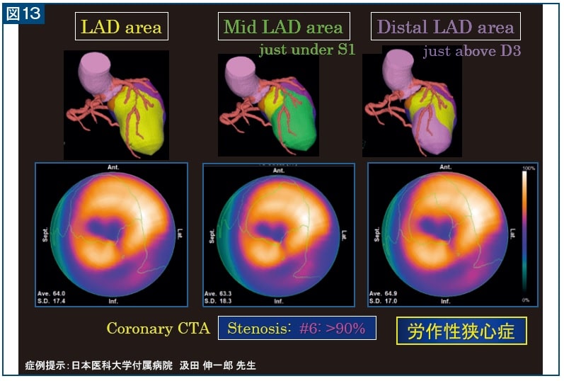 図13 右図LAD#6 90％狭窄症例。左図がLAD領域、中央図がS1を出したあとの領域です。