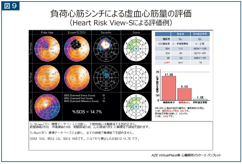 図9負荷心筋シンチによる虚血心筋量の評価(Heart Risk View-Sによる評価例)