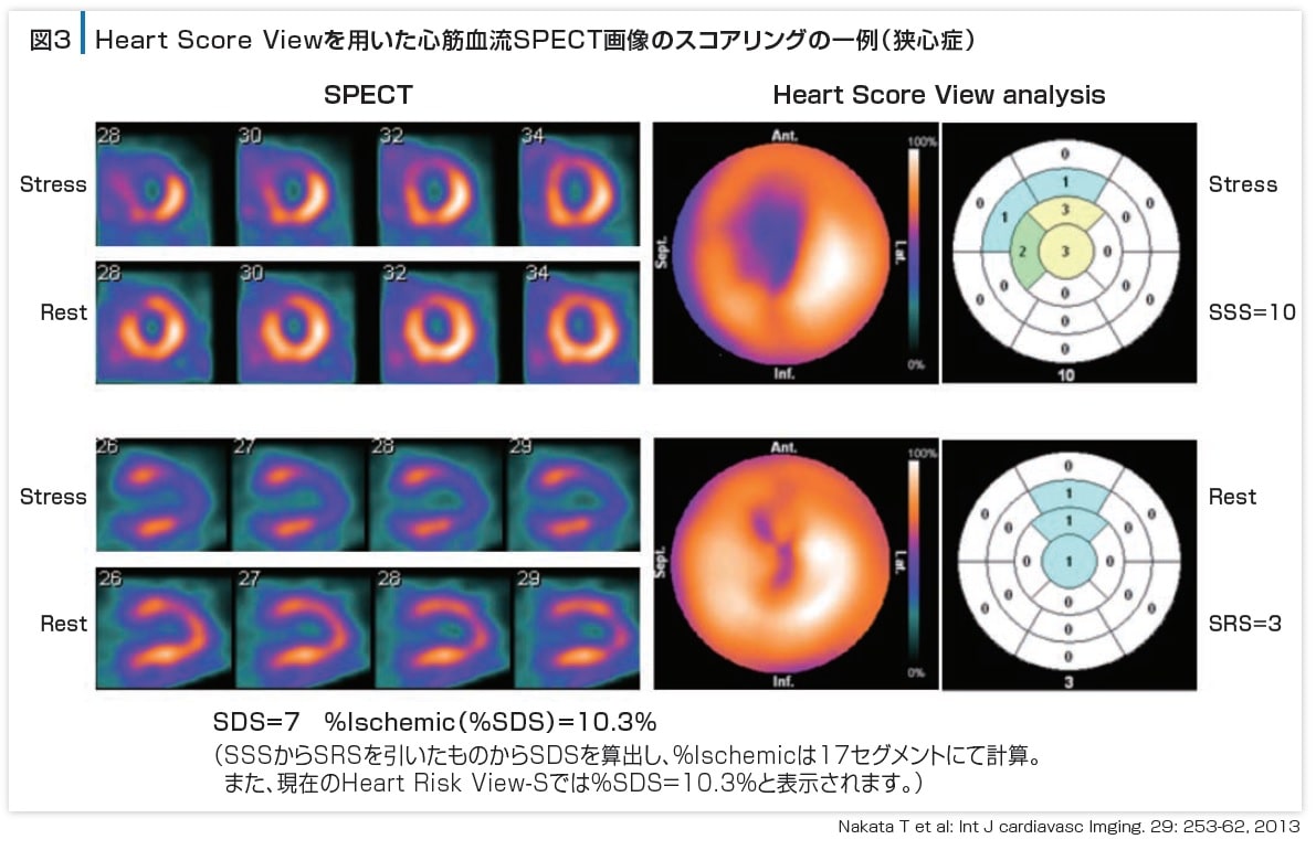 図3 Heart Score Viewを用いた心筋血流SPECT画像のスコアリングの一部（狭心症）