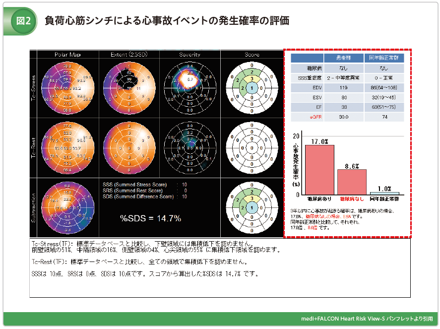 負荷心筋シンチによる事故イベント発生確率の評価