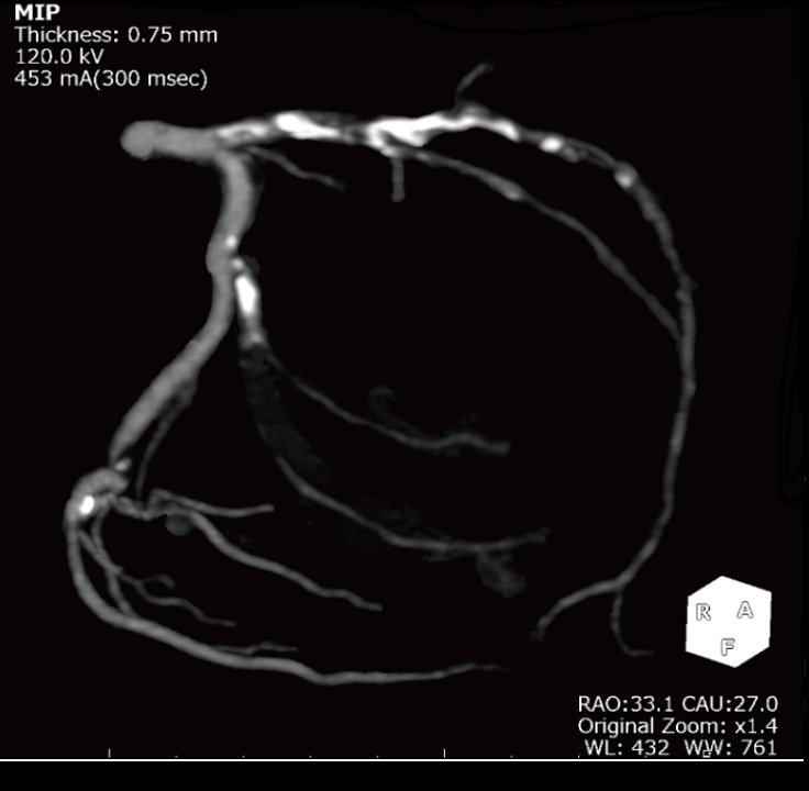 冠動脈CTA左回旋枝