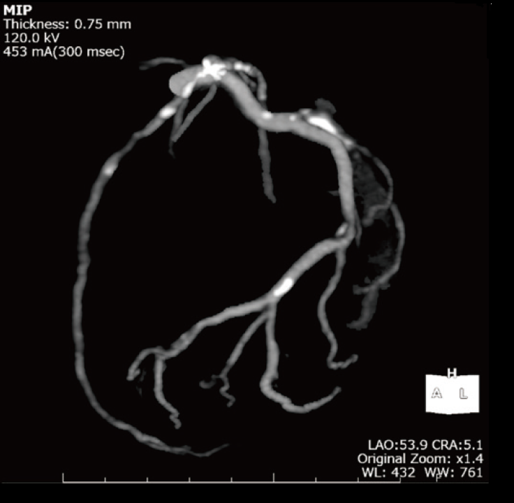 冠動脈CTA左前下行枝