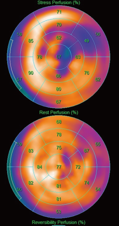 負荷心筋血流SPECT画像ポーラーマップ