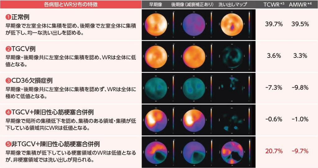 各病態における代表的なBMIPPシンチグラフィ画像およびWRとその特徴(文献5より一部改変)