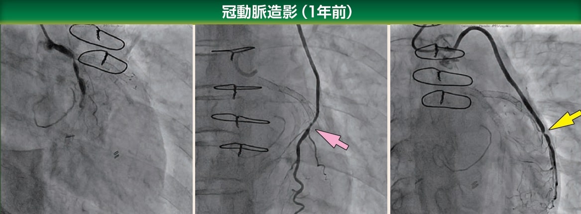 冠動脈造影　1年前　PCI画像
