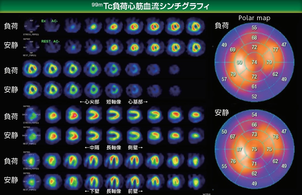 99mTC負荷心筋血流シンチグラフィ画像